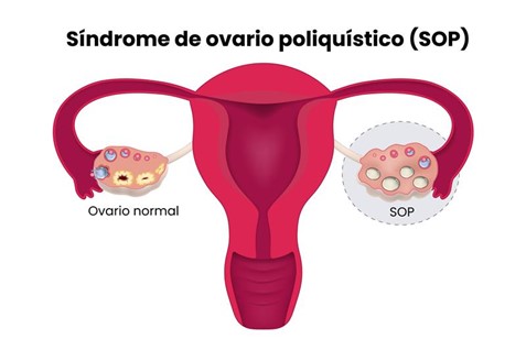 Ilustración del síndrome de ovario poliquístico comparando un ovario normal con un ovario con SOP